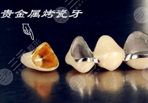 假牙材料有哪幾種類(lèi)型？