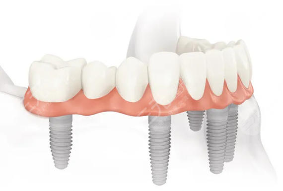 假牙材料有哪幾種類(lèi)型？