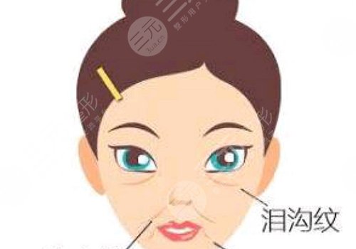 淚溝填充可以維持多久？玻尿酸、自體脂肪各不相同！