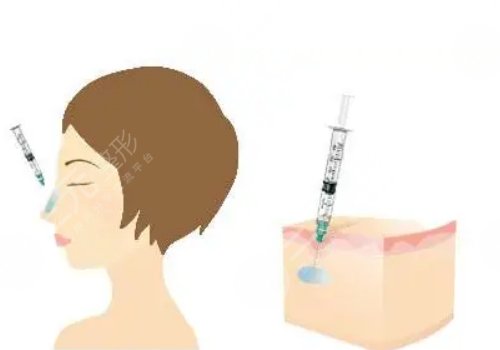 玻尿酸填充臉部有什么危害?