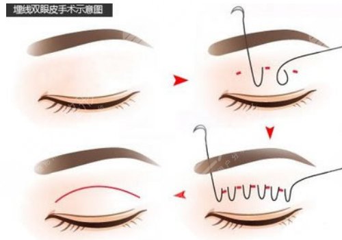 雙眼皮手術(shù)有幾種做法?