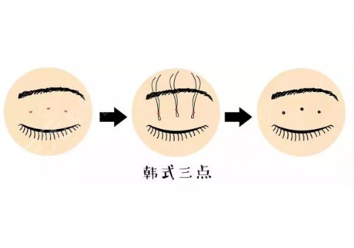 雙眼皮手術(shù)有幾種做法?