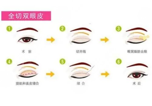 雙眼皮手術(shù)有幾種做法?