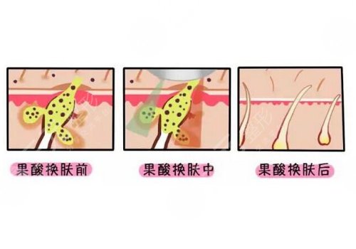 黑頭導(dǎo)出液真的有用嗎?