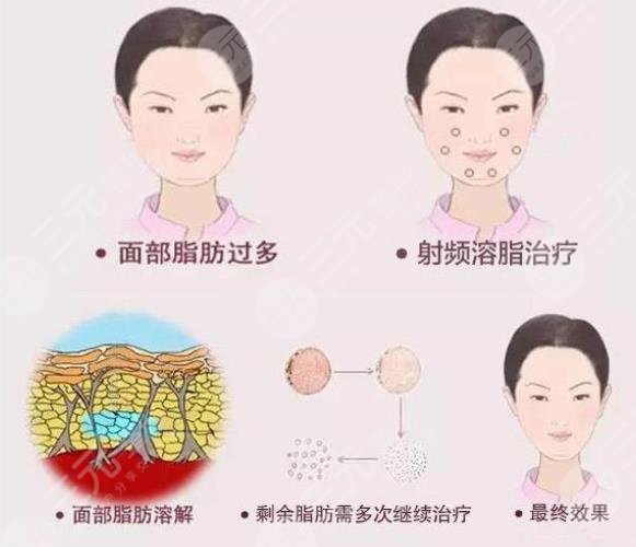 做了鐳射溶脂之后需要注意什么?