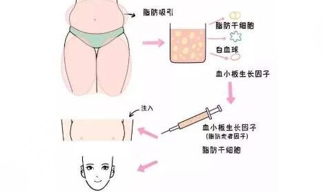 全臉脂肪填充怎么做呢？