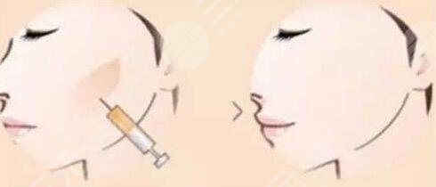 全臉脂肪填充的好處