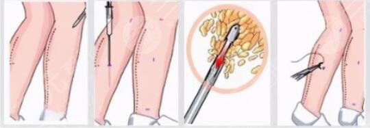 小腿吸脂術(shù)效果好嗎？