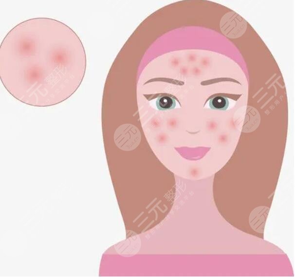 痤瘡的緩解方法有哪些？從生活作息、飲食習(xí)慣、藥物緩解等方面下手！