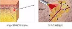 光纖溶脂瘦小腿怎么樣？原理、維持時(shí)間等預(yù)覽！肉肉腿必看~