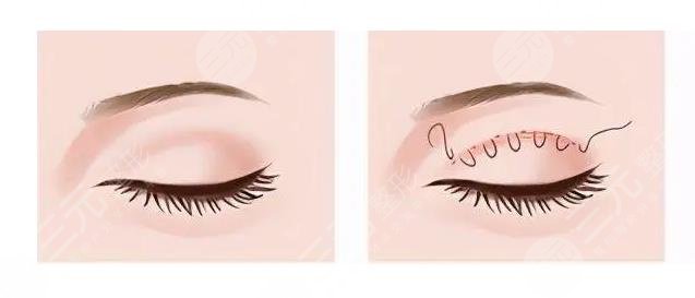 三點和歐式雙眼皮哪個好?看?