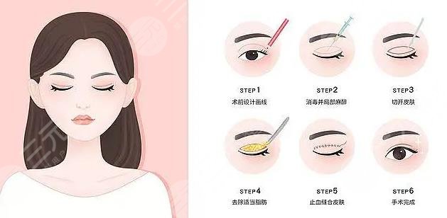 三點和歐式雙眼皮哪個好?看?