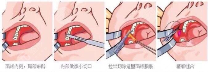 去頰脂墊手術(shù)是什么原理?