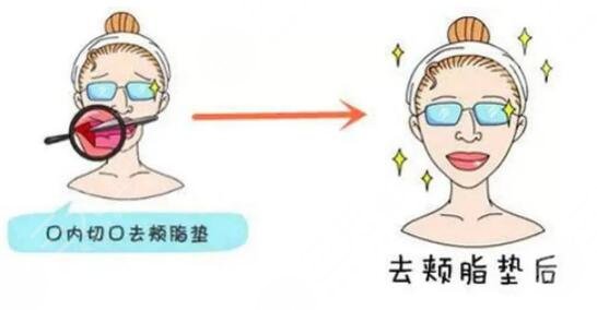 去頰脂墊后遺癥可能有哪些?