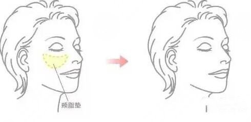 去頰脂墊的注意事項(xiàng)