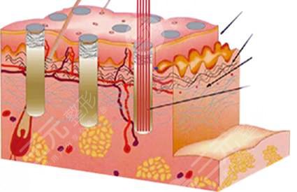 做激光去痘痘的原理是?什么呢?