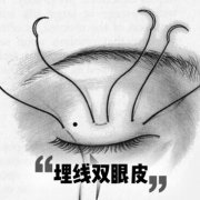 埋線雙眼皮多久恢復(fù)自然？科普解答，美眼別心急，深度了解！