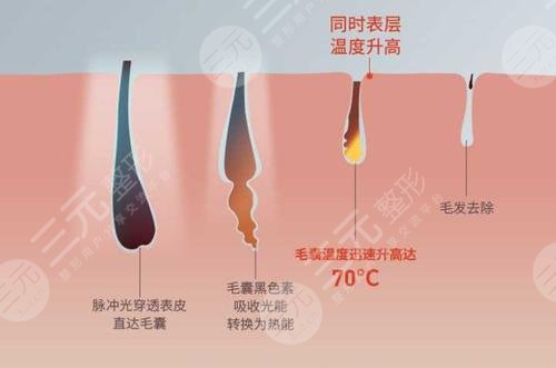 激光脫毛多長時(shí)?間一次?