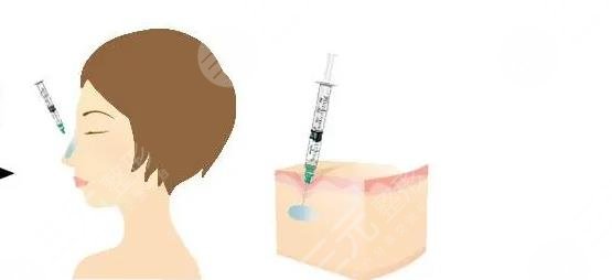 玻尿酸隆鼻會(huì)不會(huì)鼻梁越來(lái)越寬?