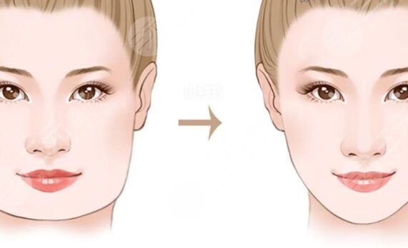 削骨瘦臉之后需要注意什么?