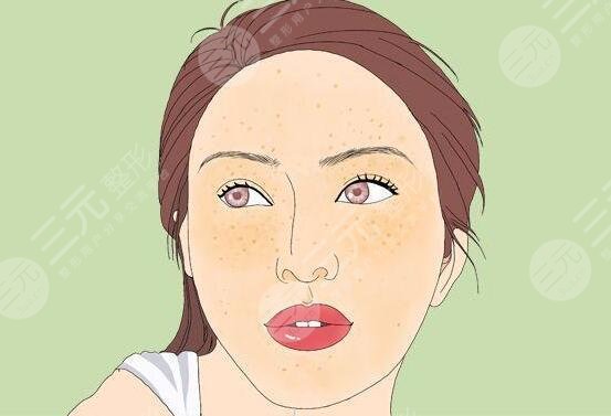 激光緩解黃褐斑多少錢一個療程?