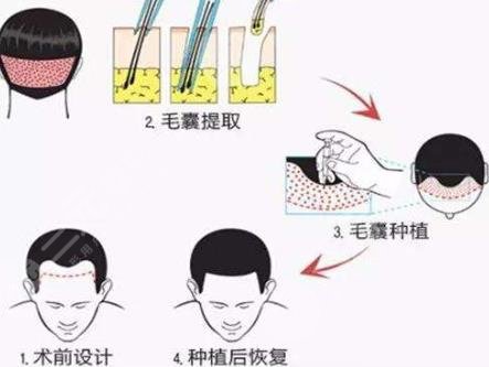 脫發(fā)是由什么引起的?