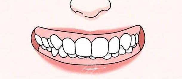 深覆合一定要做矯正嗎？深覆合矯正前后臉型對比圖|合適的年紀是多久？