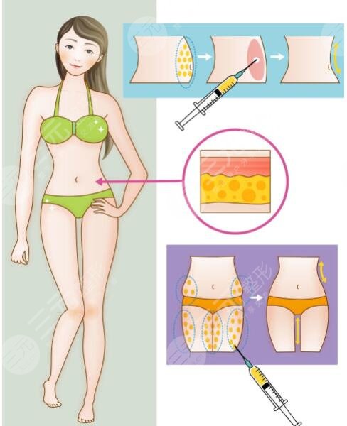 抽脂肪會(huì)不會(huì)反彈越來(lái)越胖？