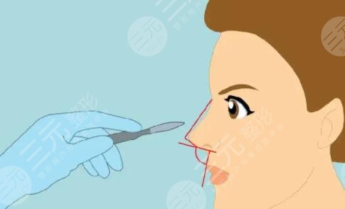 蒜頭鼻怎么變小？