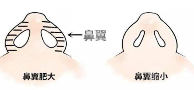 蒜頭鼻縮小整形手術(shù)可以維持多長時(shí)間?