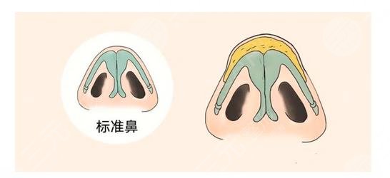 縮鼻翼和鼻頭多少錢(qián)?