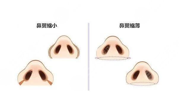 縮鼻翼和鼻頭多少錢(qián)?