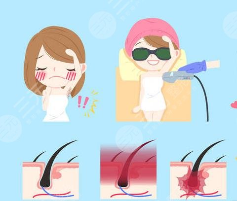 光子脫毛的危害