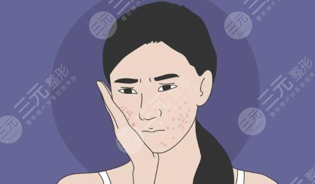 能治好臉上的痘痘嗎？的功效和作用是什么？對皮膚的好處和壞處一覽~