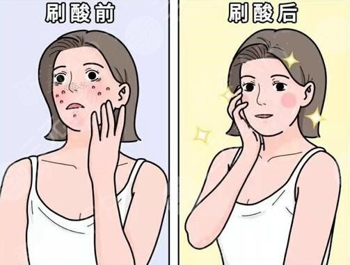 去除痘痘之后多長時間可以恢復?