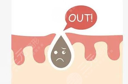 黑頭產(chǎn)生的原因