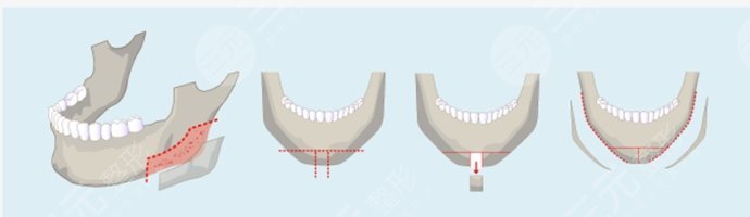 整瓜子臉磨骨多?少錢?