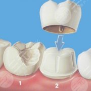 門牙有縫怎么緩解比較合理？烤瓷牙矯正、戴牙套等優(yōu)勢(shì)分析！