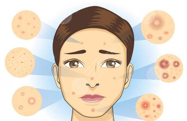 如何快速去除痤瘡見效快?