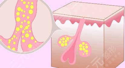 像素激光去痘疤有?效果嗎?