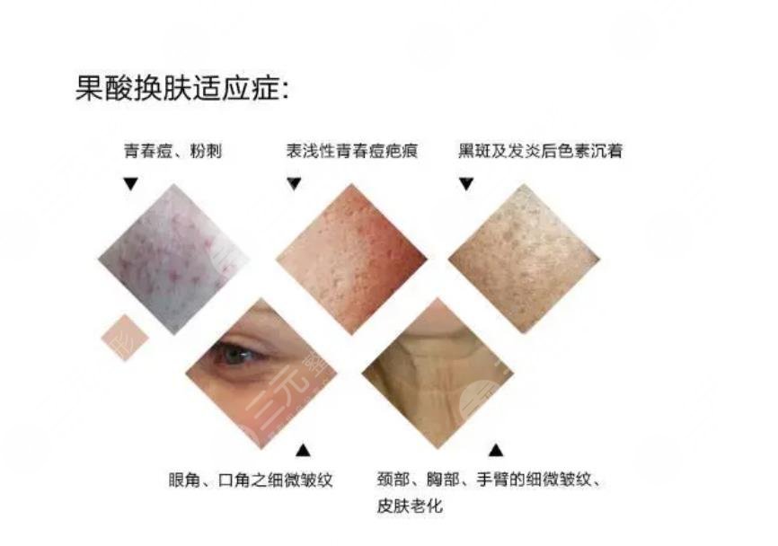 果酸煥膚怎么護理