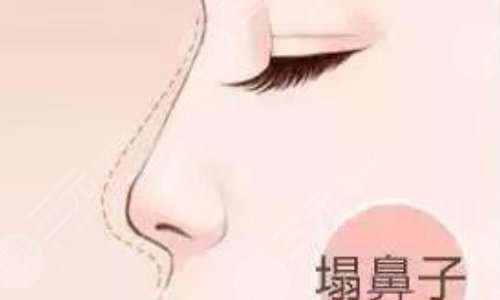 奧美定隆鼻有什么副作用？