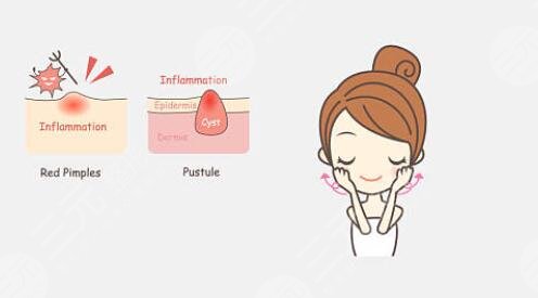 激光祛痘能徹底去掉嗎?