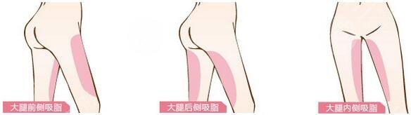 腿部吸脂減肥會(huì)不會(huì)反彈?