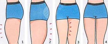 腿部吸脂減肥價(jià)格貴嗎2023同步更新？術(shù)后會(huì)反彈嗎？塑形效果好不好？