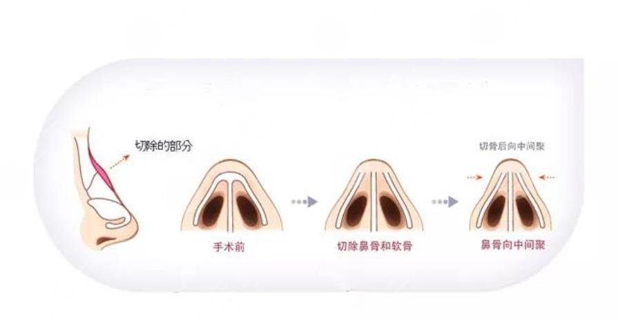 駝峰鼻手術(shù)一般多少錢?