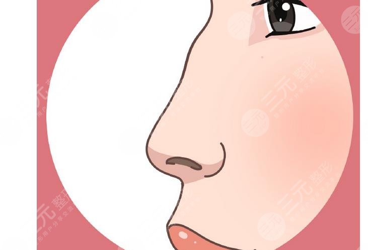 駝峰鼻矯正適合哪些人群?