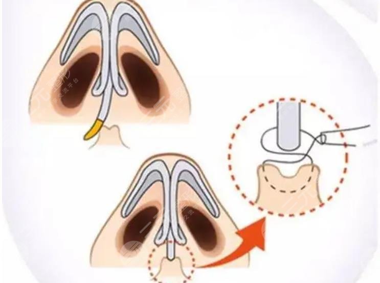 駝峰鼻矯正適合哪些人群?