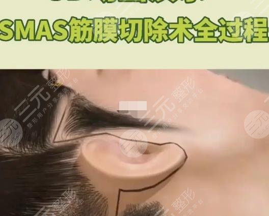 筋膜提升術(shù)