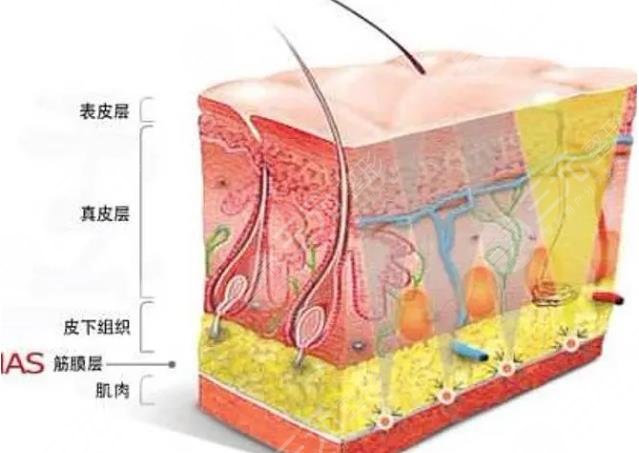 筋膜提升術(shù)